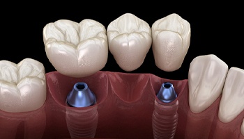 Dental implant bridge in Danville