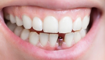 Close up of a smile with a tooth replaced by a dental implant